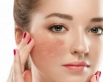 Bí quyết xóa nám bằng thảo dược tự nhiên – An toàn cho phụ nữ sau 30
