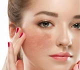 Bí quyết xóa nám bằng thảo dược tự nhiên – An toàn cho phụ nữ sau 30